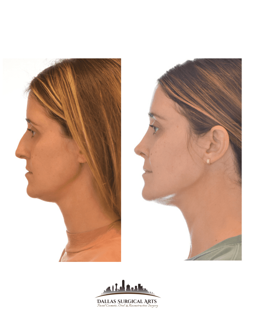 of Nose Shape with Dr. Randy Sanovich, BoardCertified Surgeon at Dallas Surgical Arts