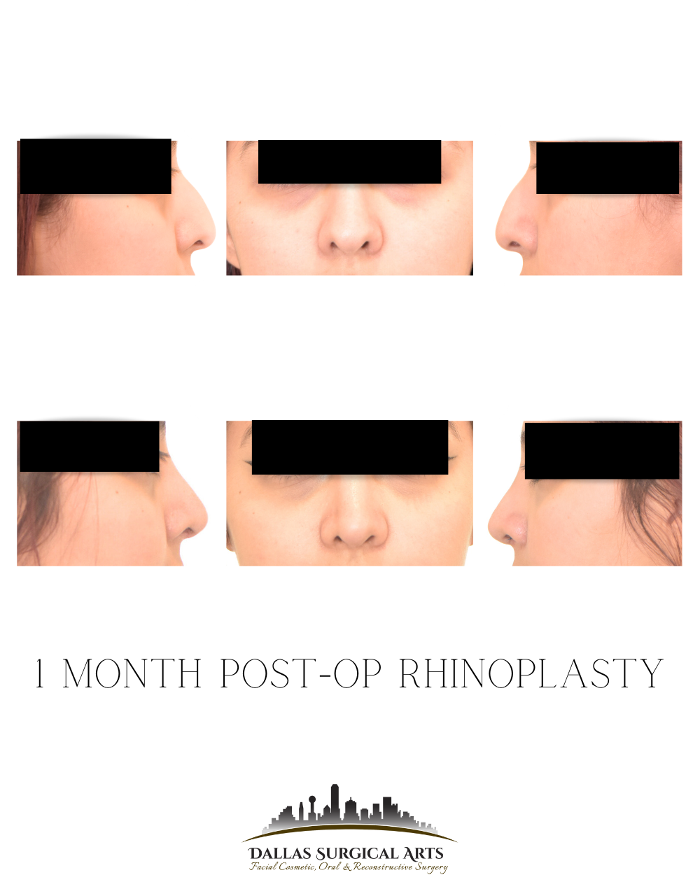 The Latest Trends in Rhinoplasty for 2025