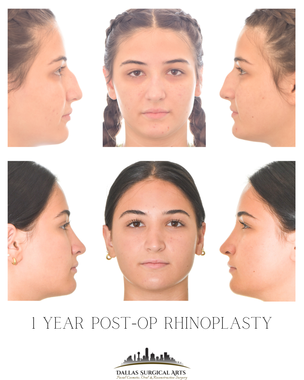 Rhinoplasty in Dallas: Reddit Insights on Nose Job Surgeons