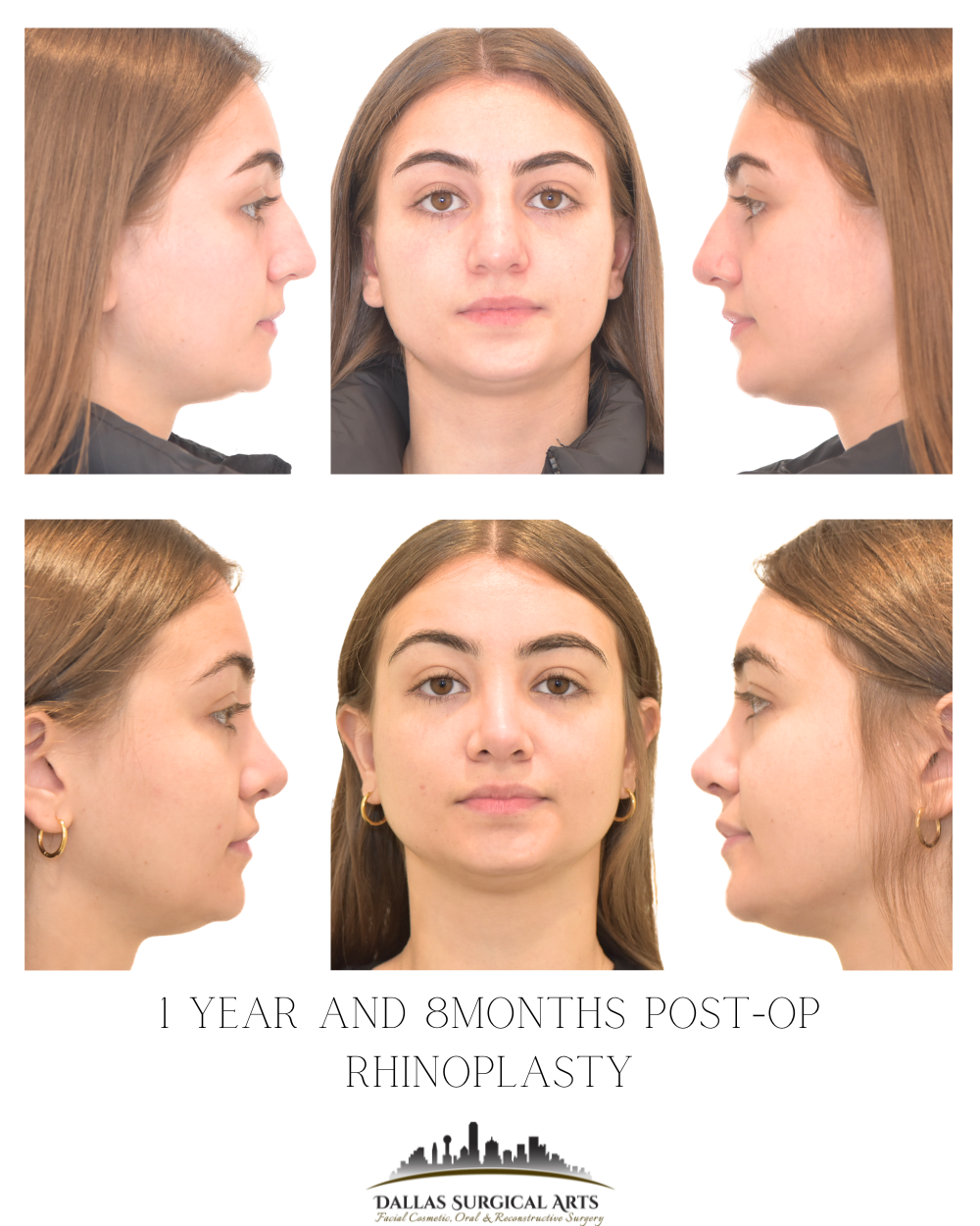 Dallas Rhinoplasty Surgeon Insights: Cost of a Rhinoplasty Explained
