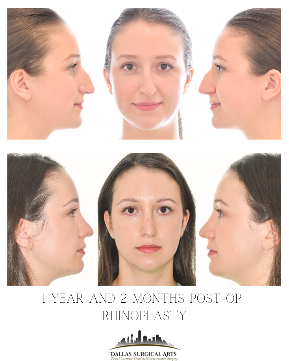Fixing a Broken Nose Years Later - What to Expect