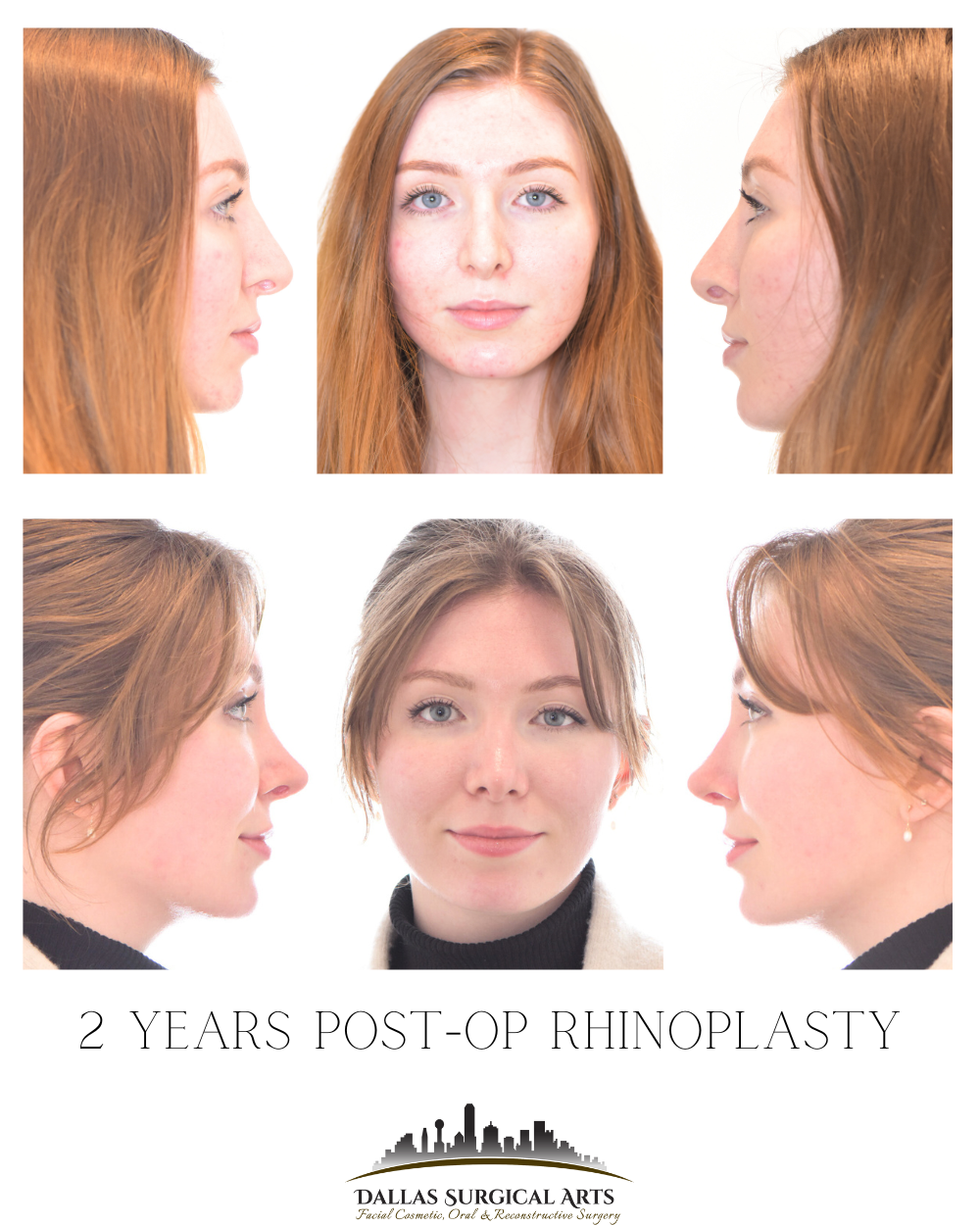 How Rhinoplasty Can Transform Different Nose Shapes
