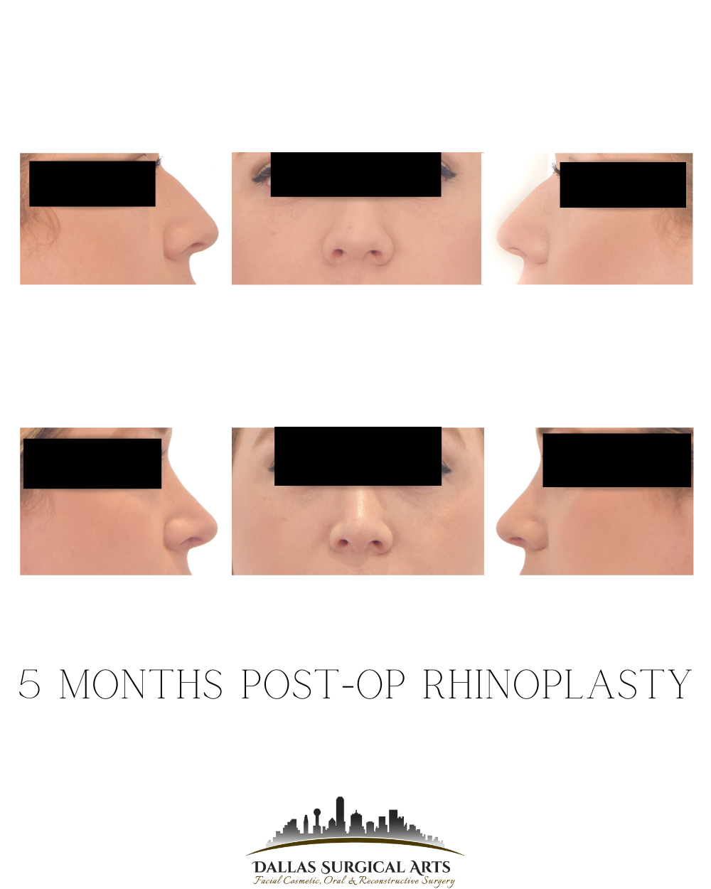 Button Nose Surgery Before and After