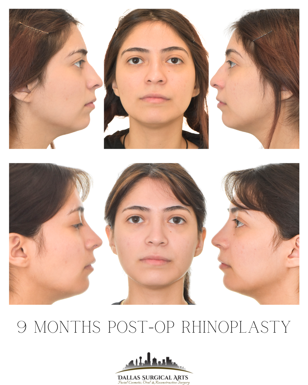 How Long is Recovery for a Rhinoplasty? What to Expect from Nose Surgery in Dallas