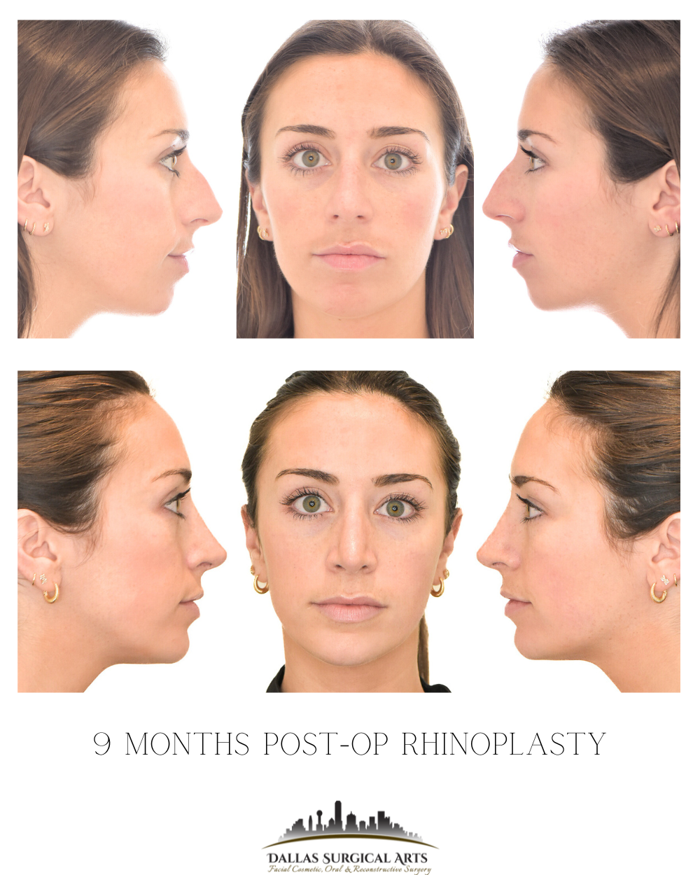 Dallas Rhinoplasty Surgeon Talks About Combining Nose Surgery with Genioplasty