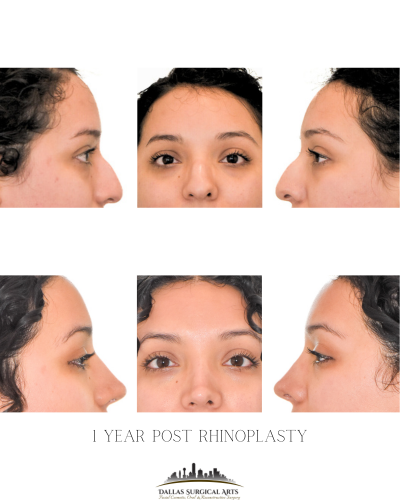 Dallas Surgeon for a Deviated Septum - Restoring Breathing and Function to Your Nose Through Rhinoplasty