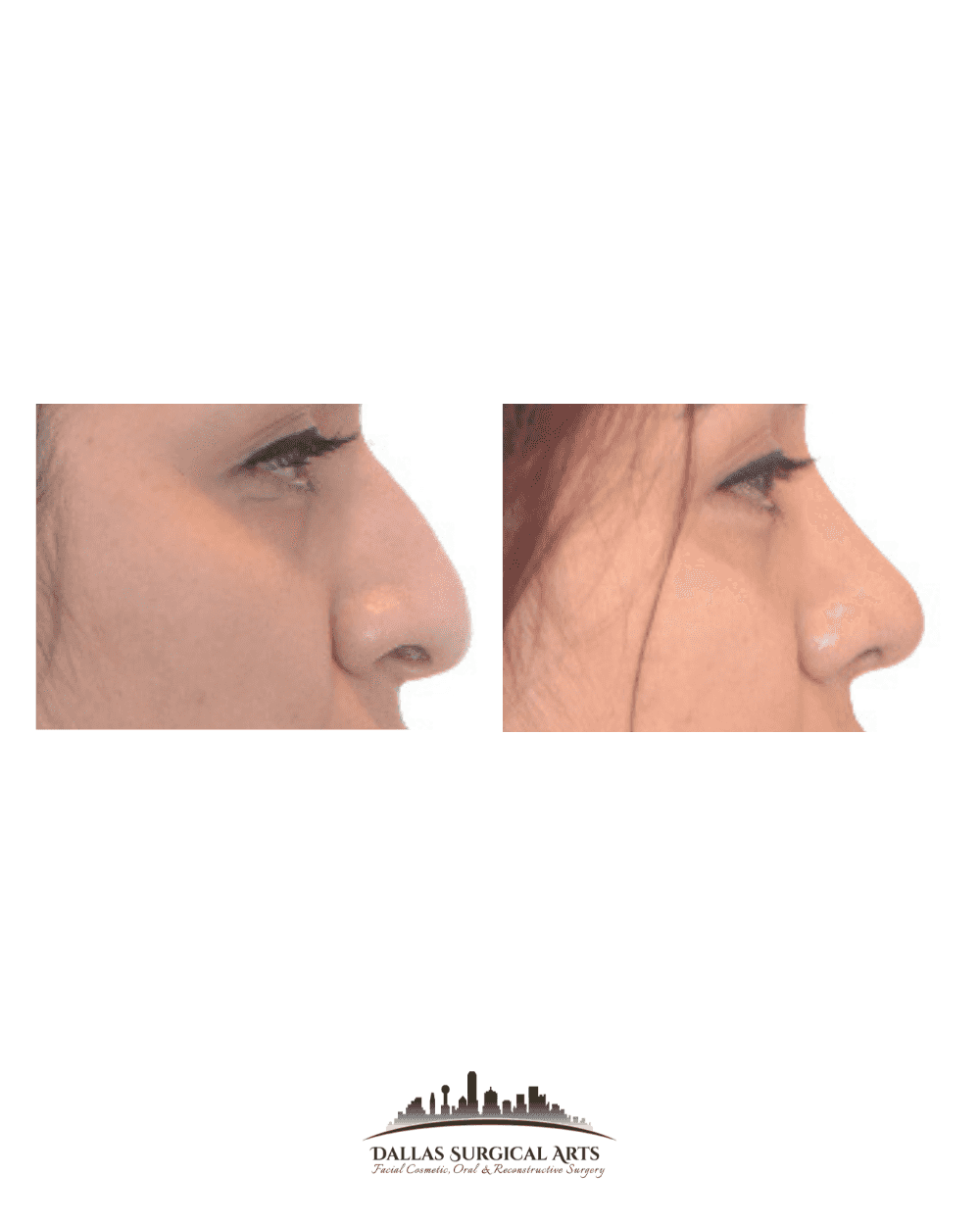 The Art of Rhinoplasty in Dallas with Dr. Randy Sanovich