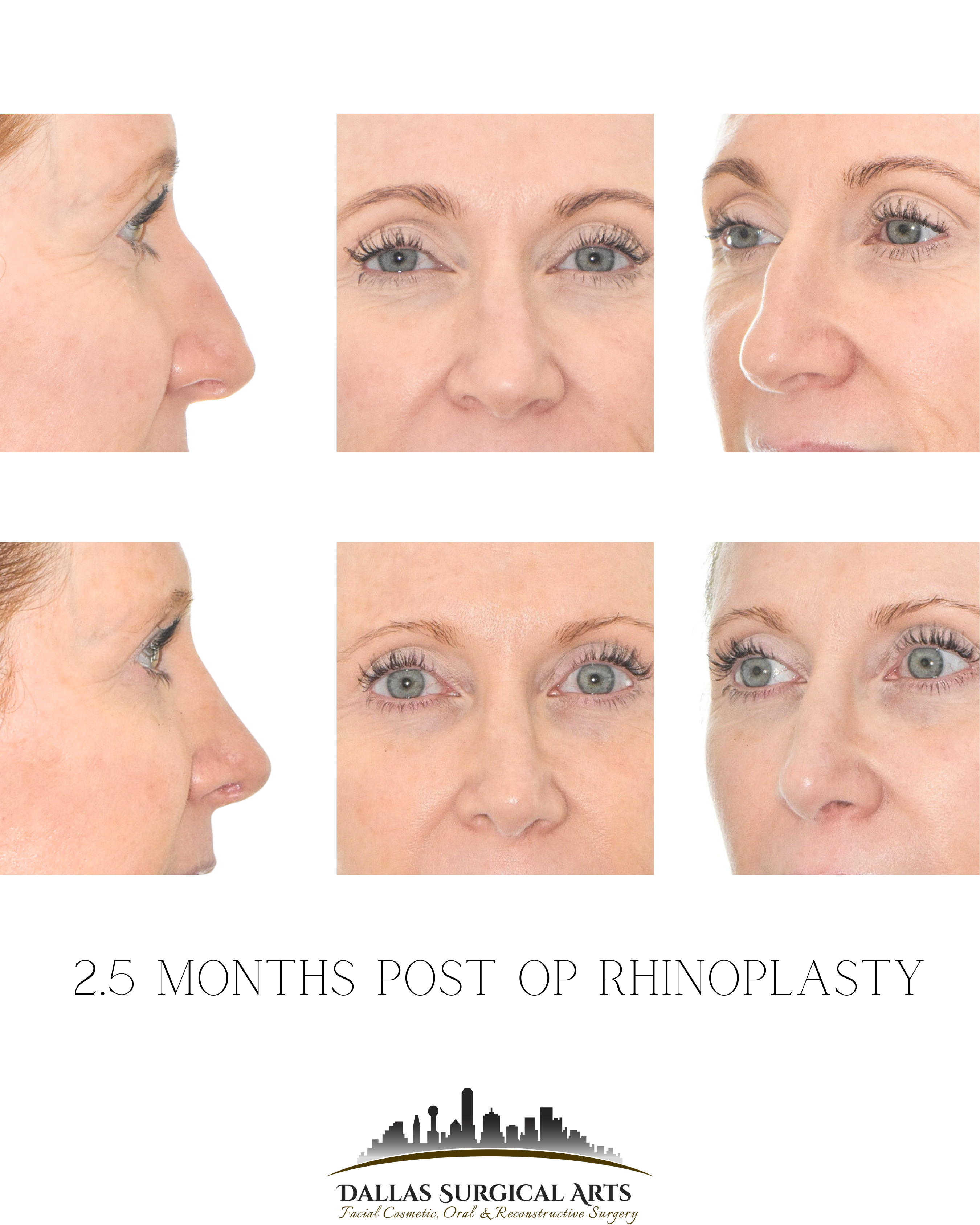 Small Nose Surgery - Learn About Nose Reduction Surgery in Dallas