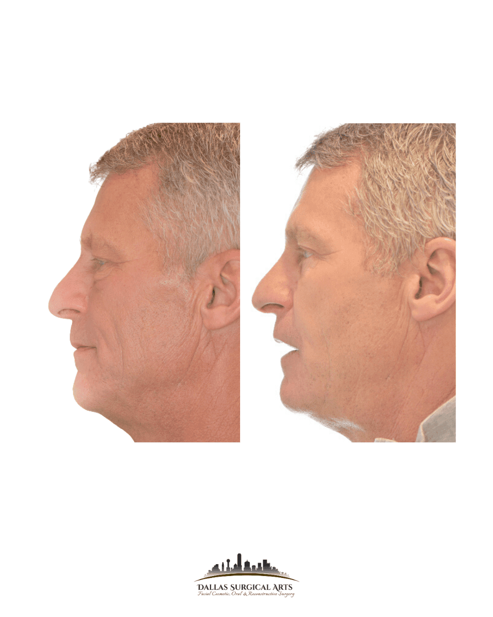 Sculptra Dallas Surgical Arts