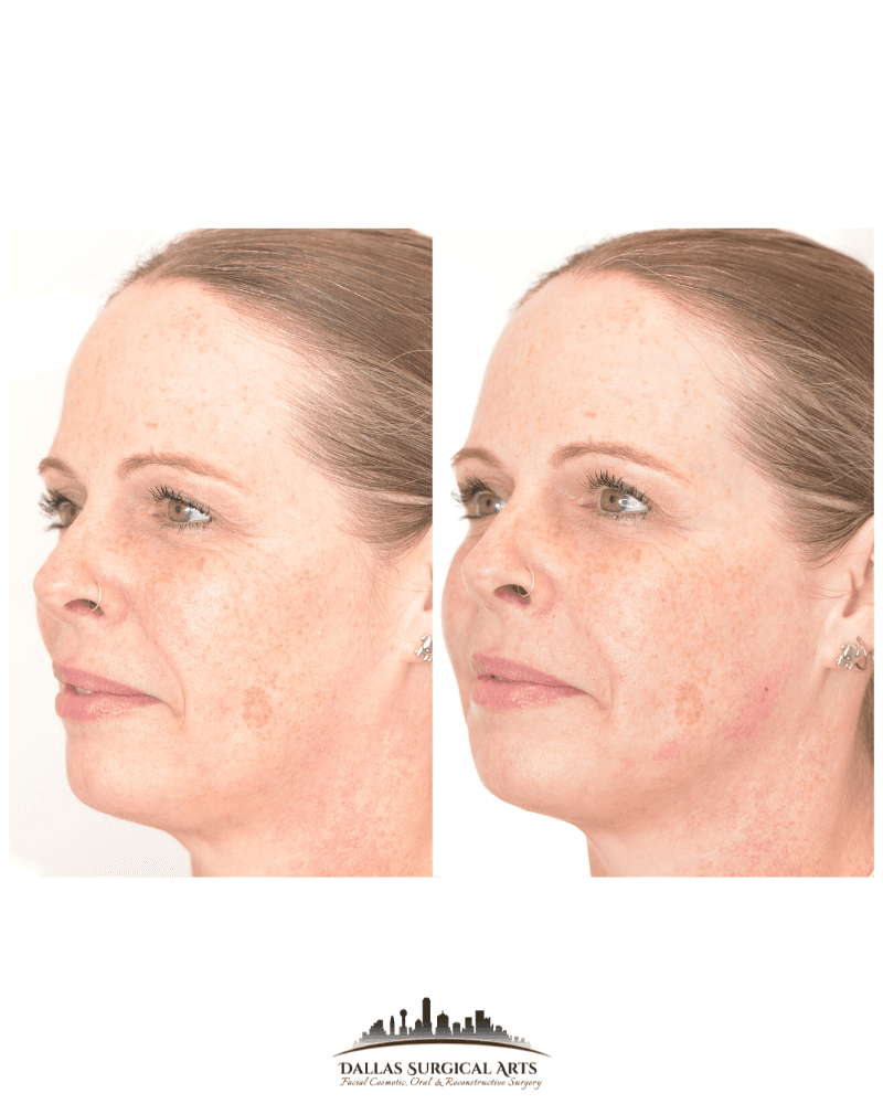 Sculptra Dallas Surgical Arts