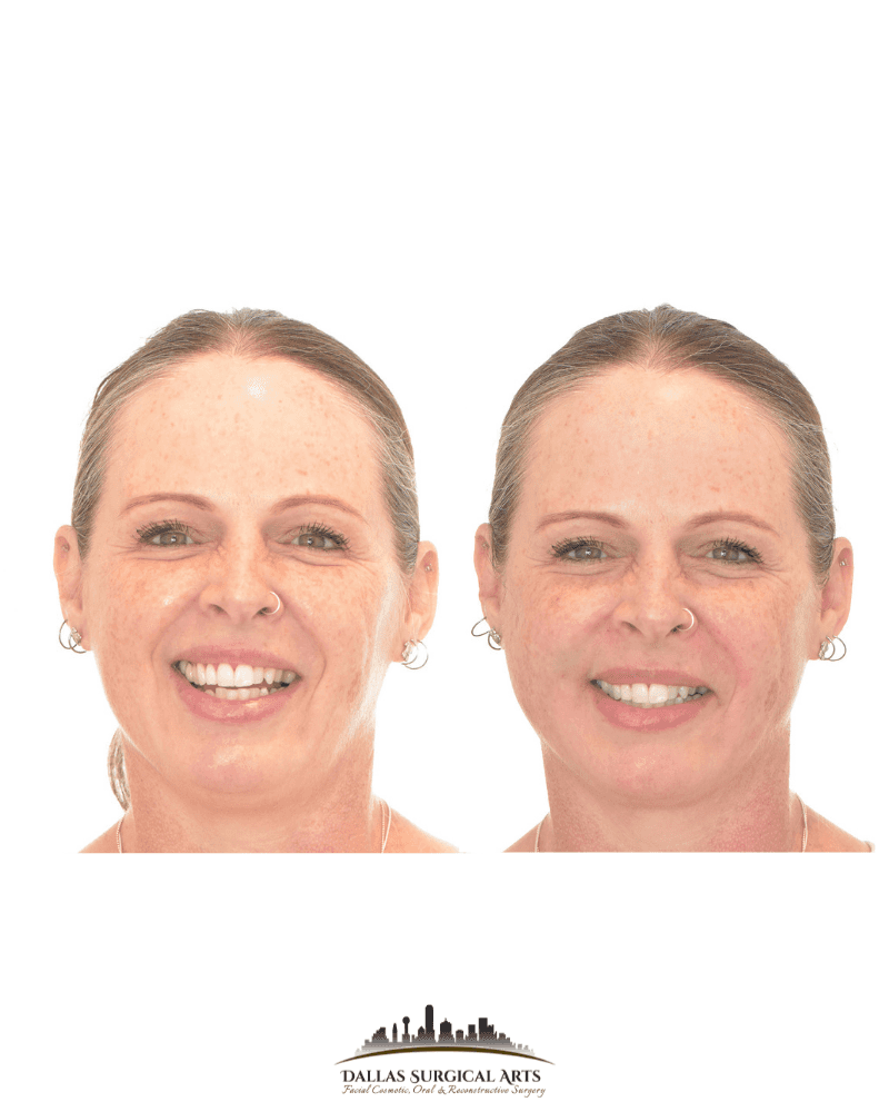 Sculptra Dallas Surgical Arts