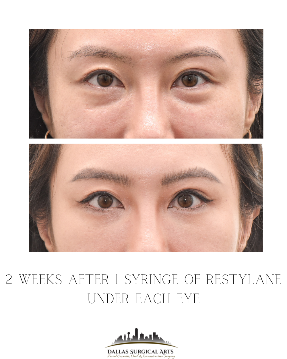 The Definitive Guide to Under Eye Filler in Dallas