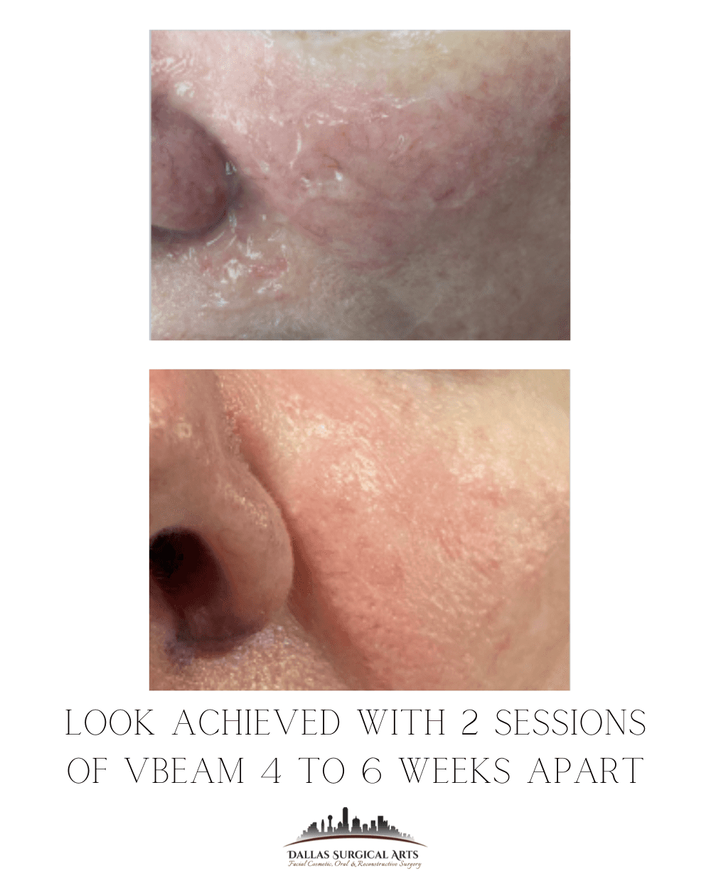 Facial Treatments in Dallas: All About Managing Rosacea