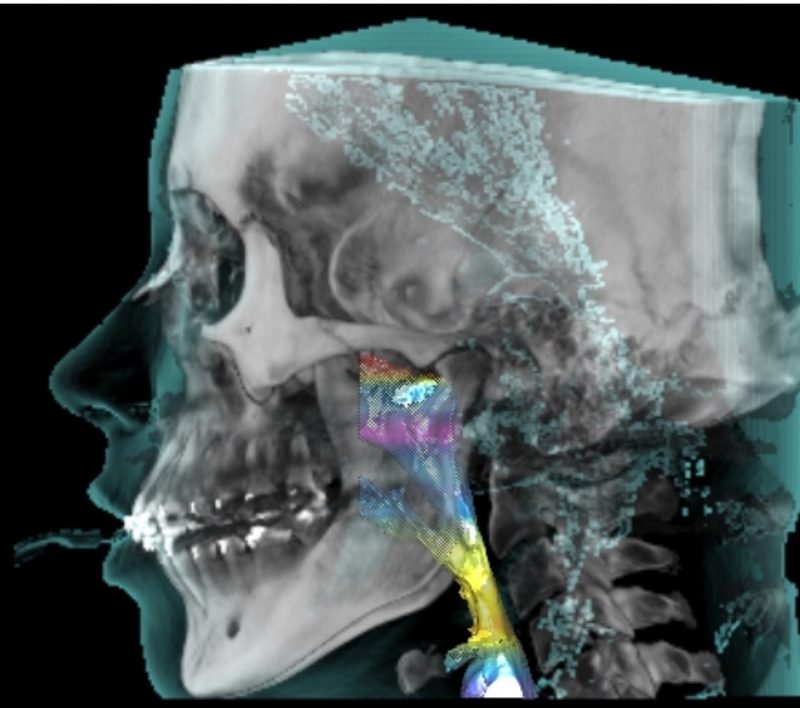 Female Jaw Repositioning for Sleep Apnea_Before