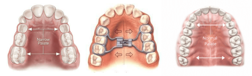 Narrow palate before and after