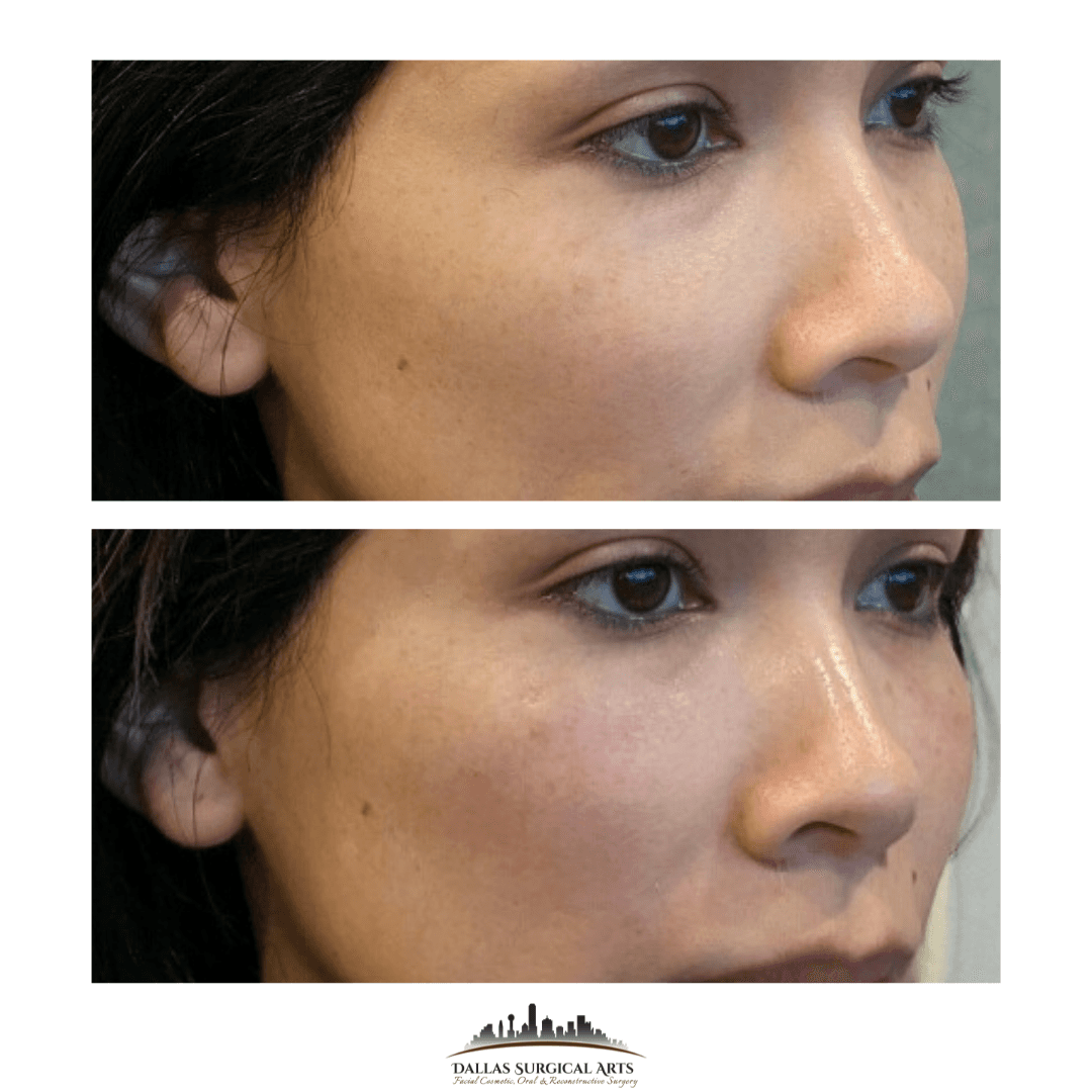 Dallas dermal filler before and after