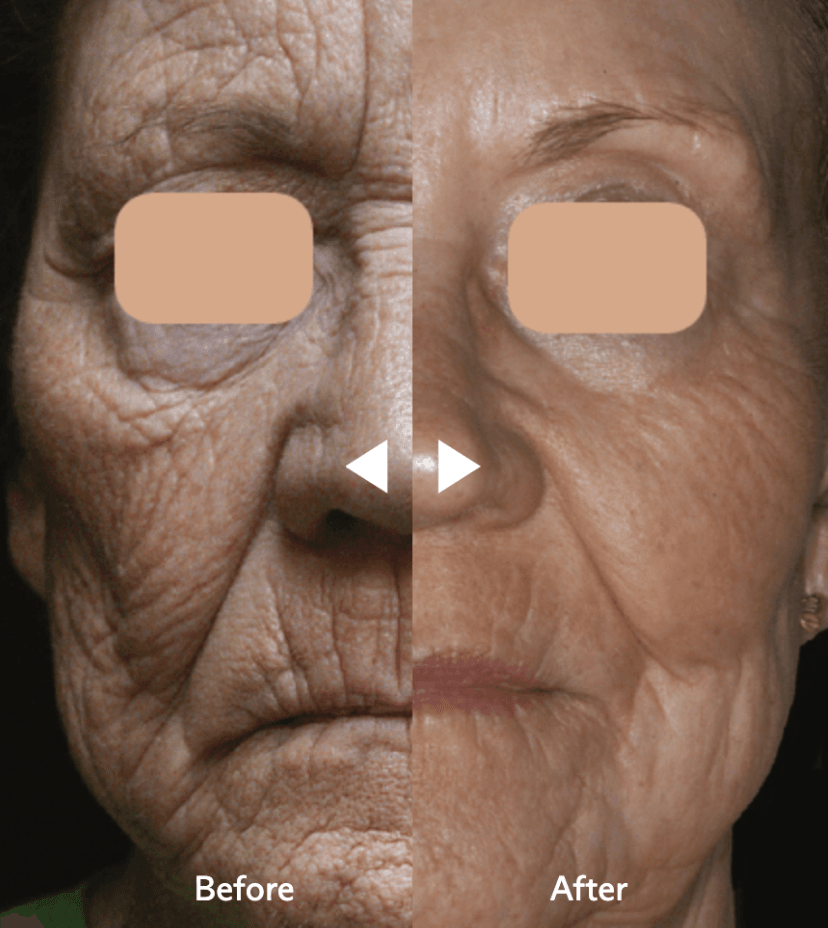 CO2 Fractional Laser Skin Resurfacing Before & After (Updated 2023